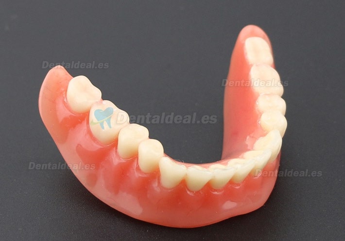 Dental Dientes inferiores Modelo de sobredentadura 2 Implantes Demostración Modelo 6002 01